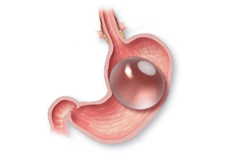 Gastric Balloon