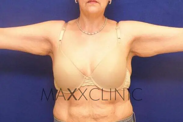 1armlift-before1
