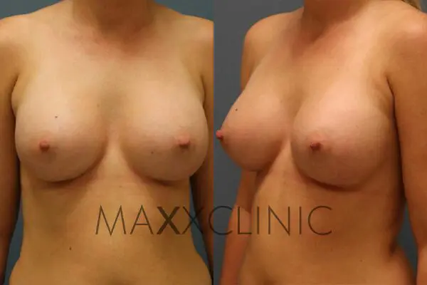 1breastaugmentation-after1