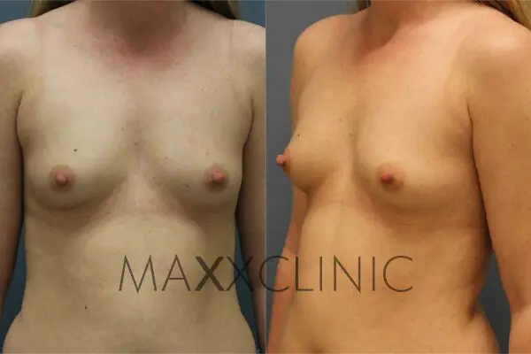 1breastaugmentation-before1
