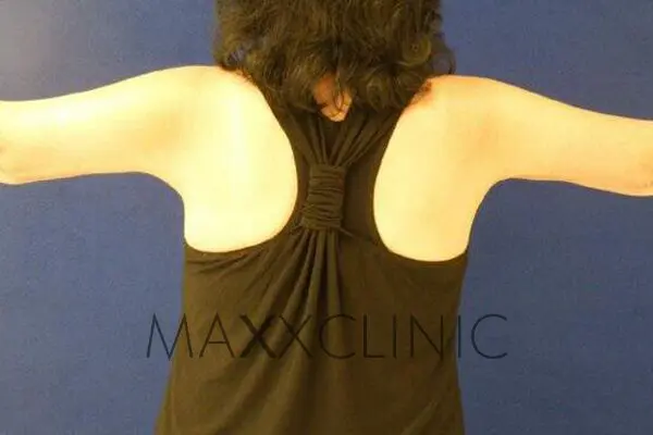 2armlift-after2