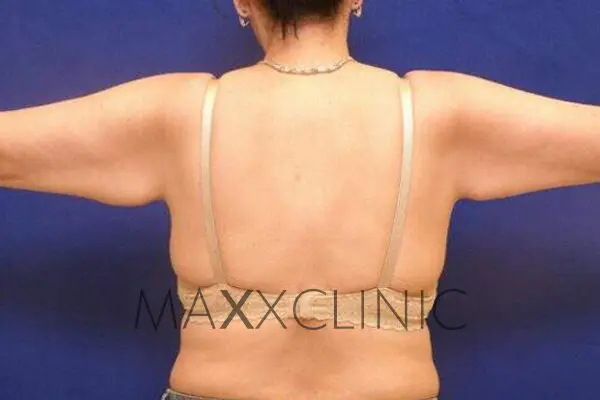 2armlift-before2