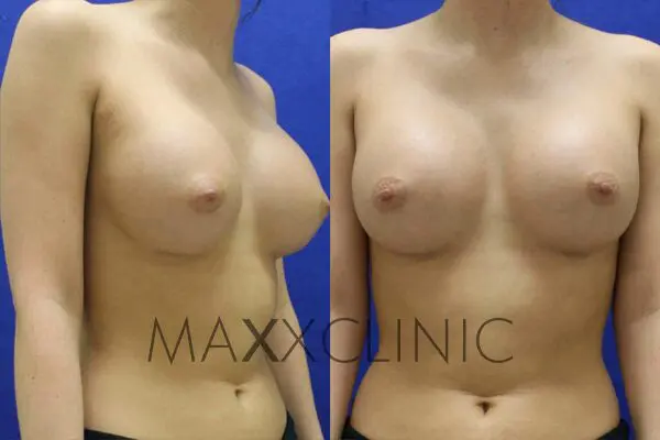2breastaugmentation-after2