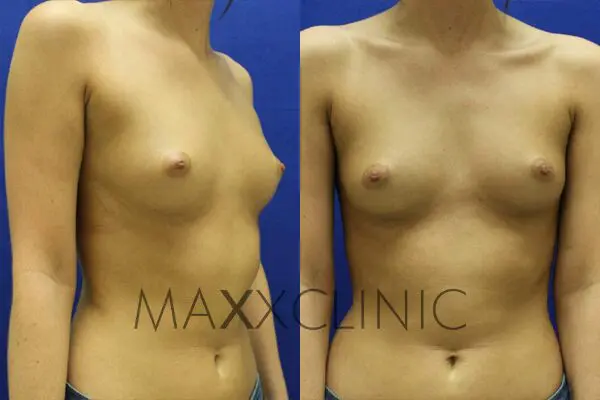 2breastaugmentation-before2