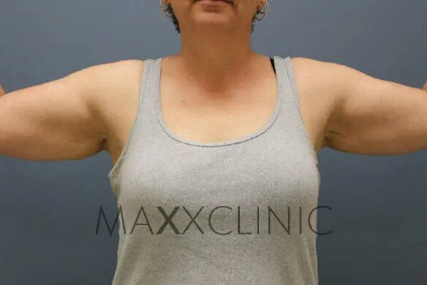 3armlift-before3