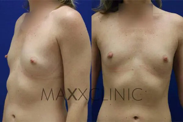 3breastaugmentation-before3