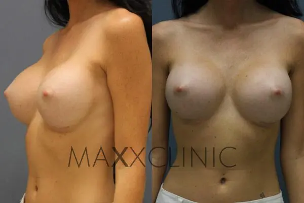 4breastaugmentation-after4