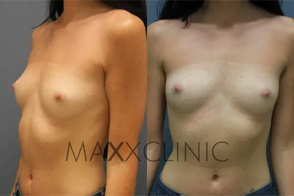 4breastaugmentation-before4