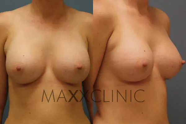 5breastaugmentation-after5