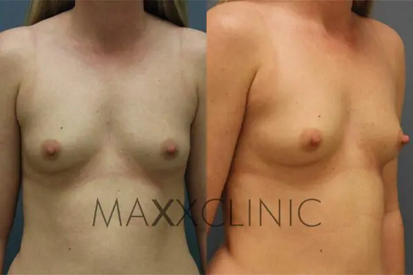 5breastaugmentation-before5