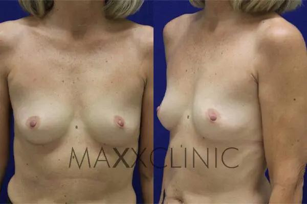 6breastaugmentation-before6