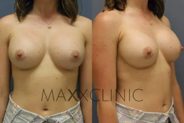 7breastaugmentation-after7