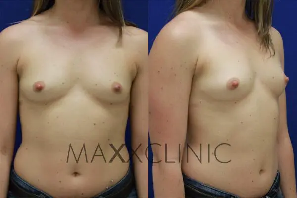 7breastaugmentation-before7