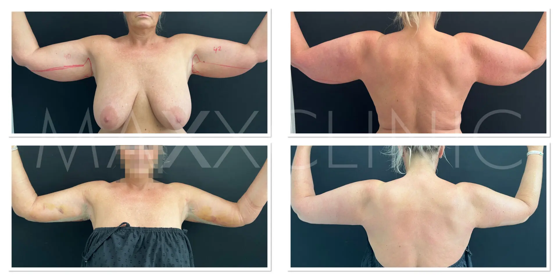 Arm Lift B-A