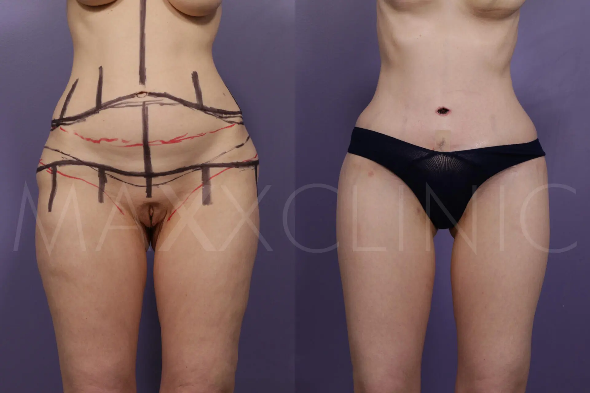 BodLift1 (1)