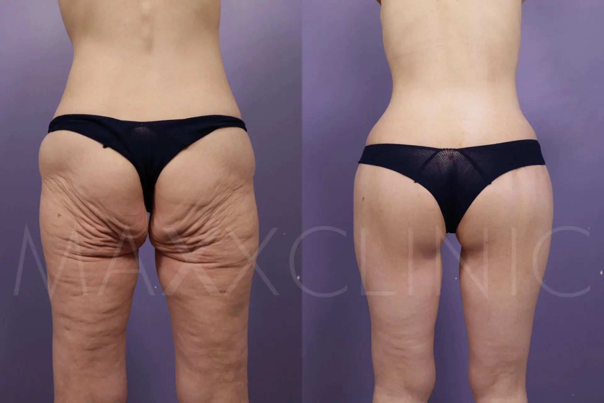 BodLift1 (2)