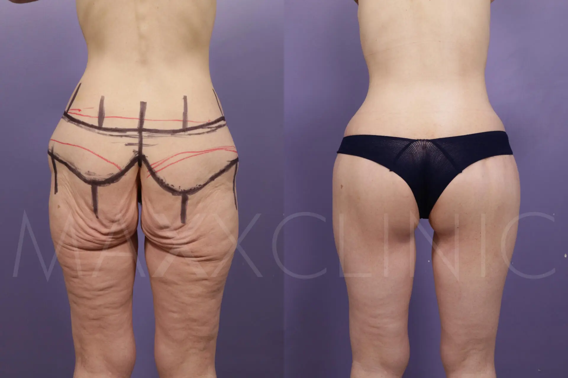 BodLift1 (3)