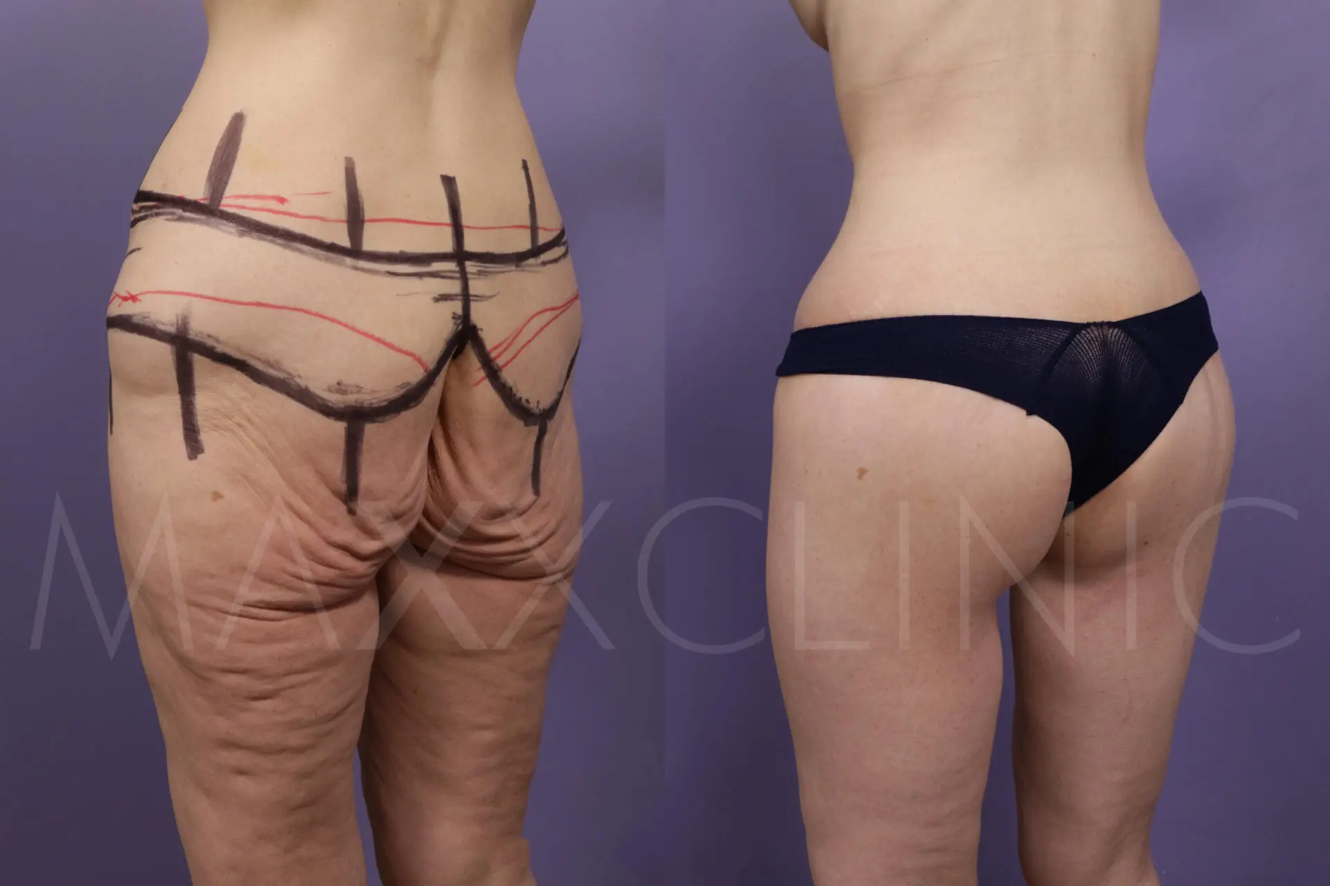 BodLift1 (4)
