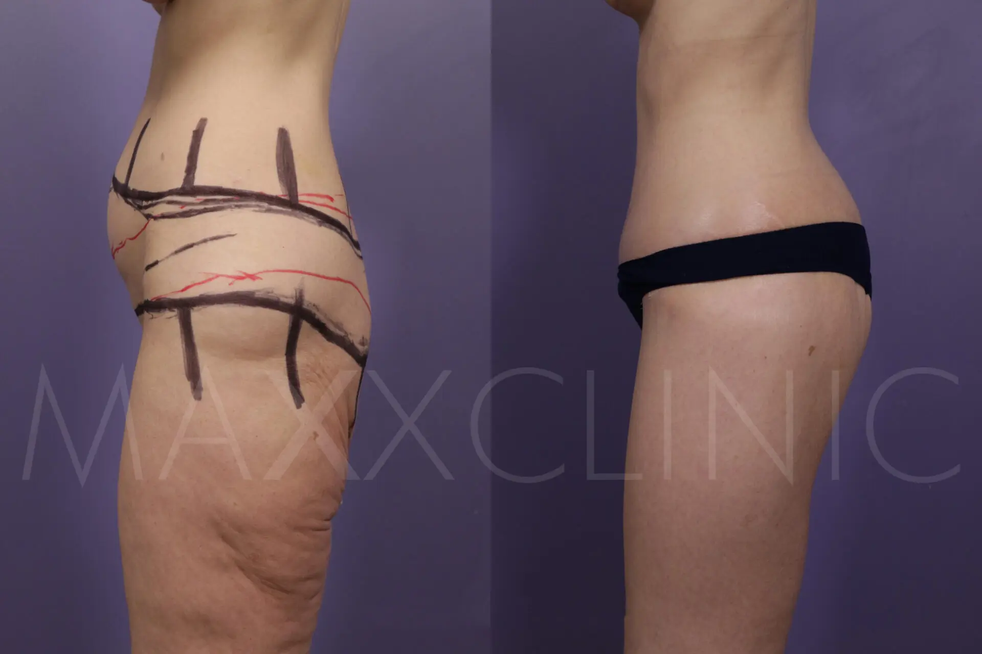 BodLift1 (5)