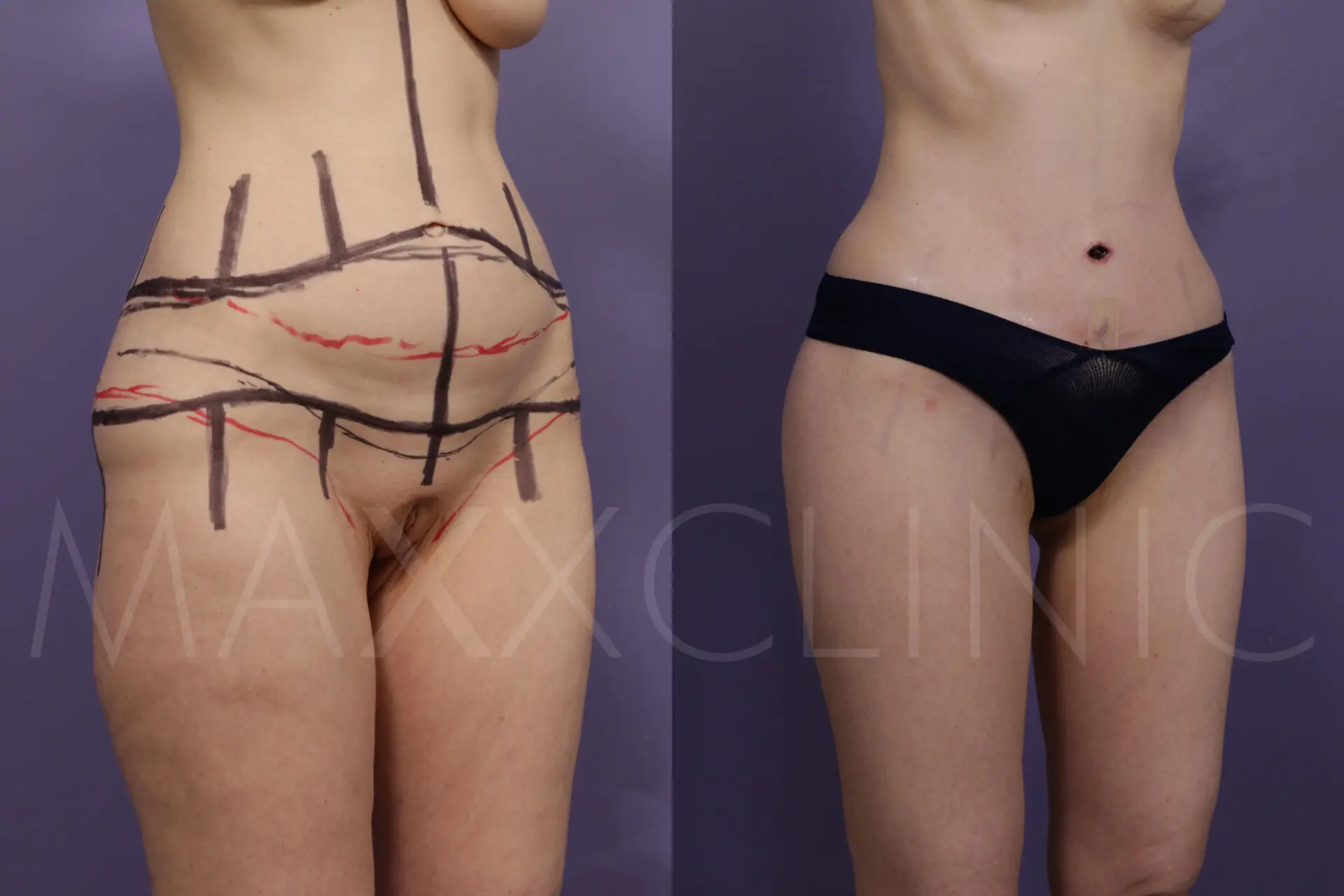 BodLift1 (6)