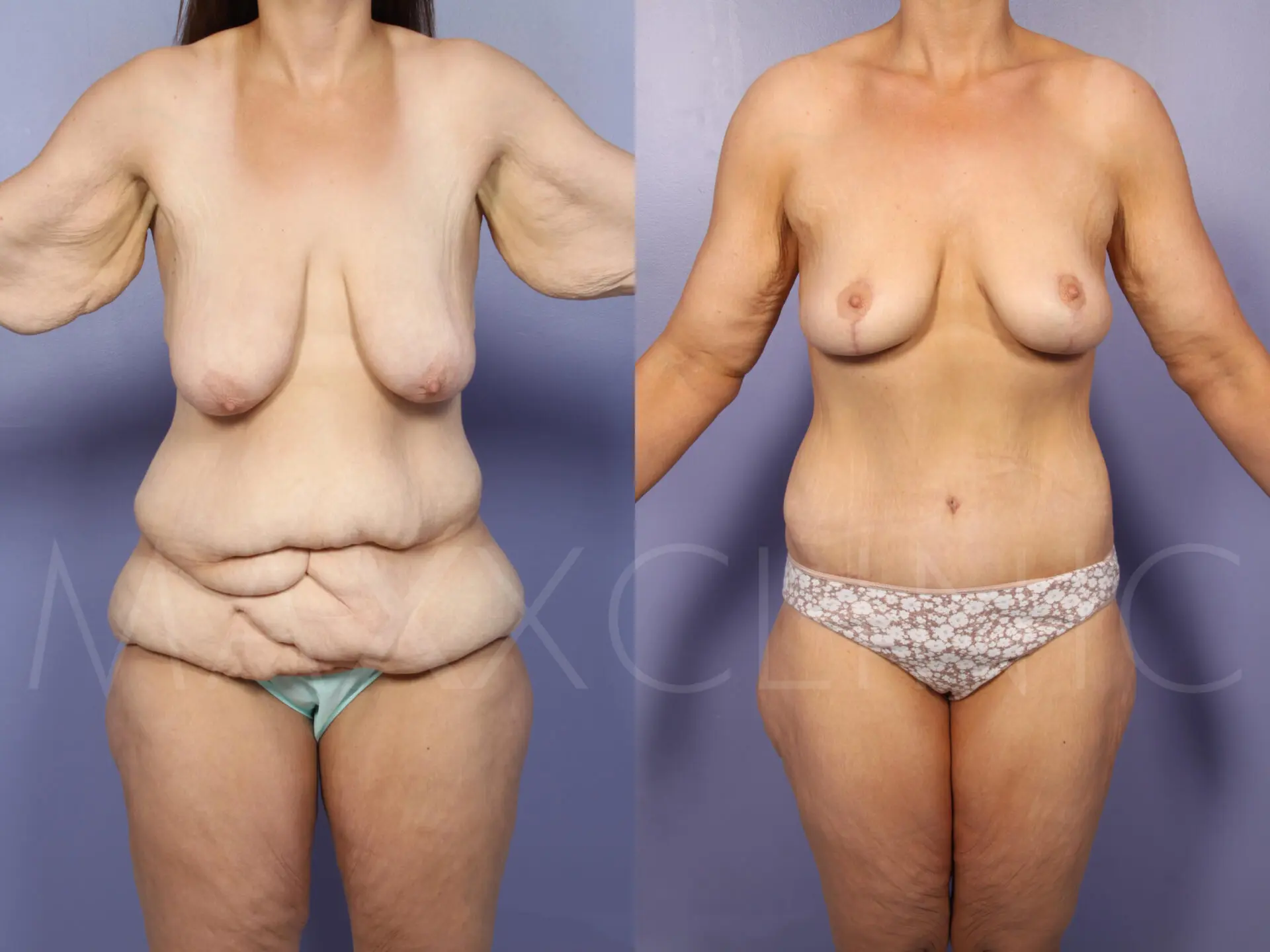 BodyLift2 (1)