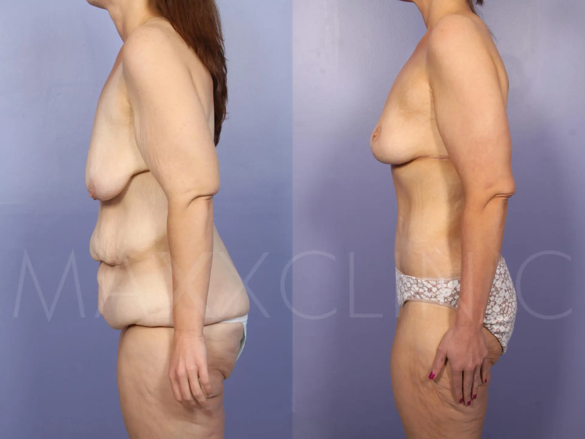 BodyLift2 (2)