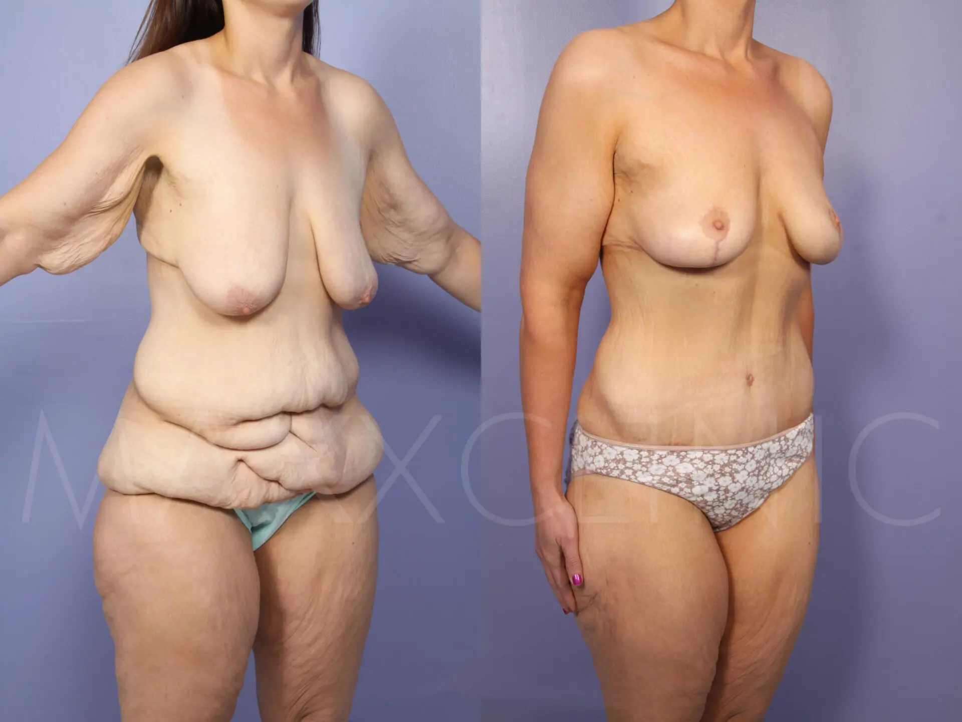 BodyLift2 (3)