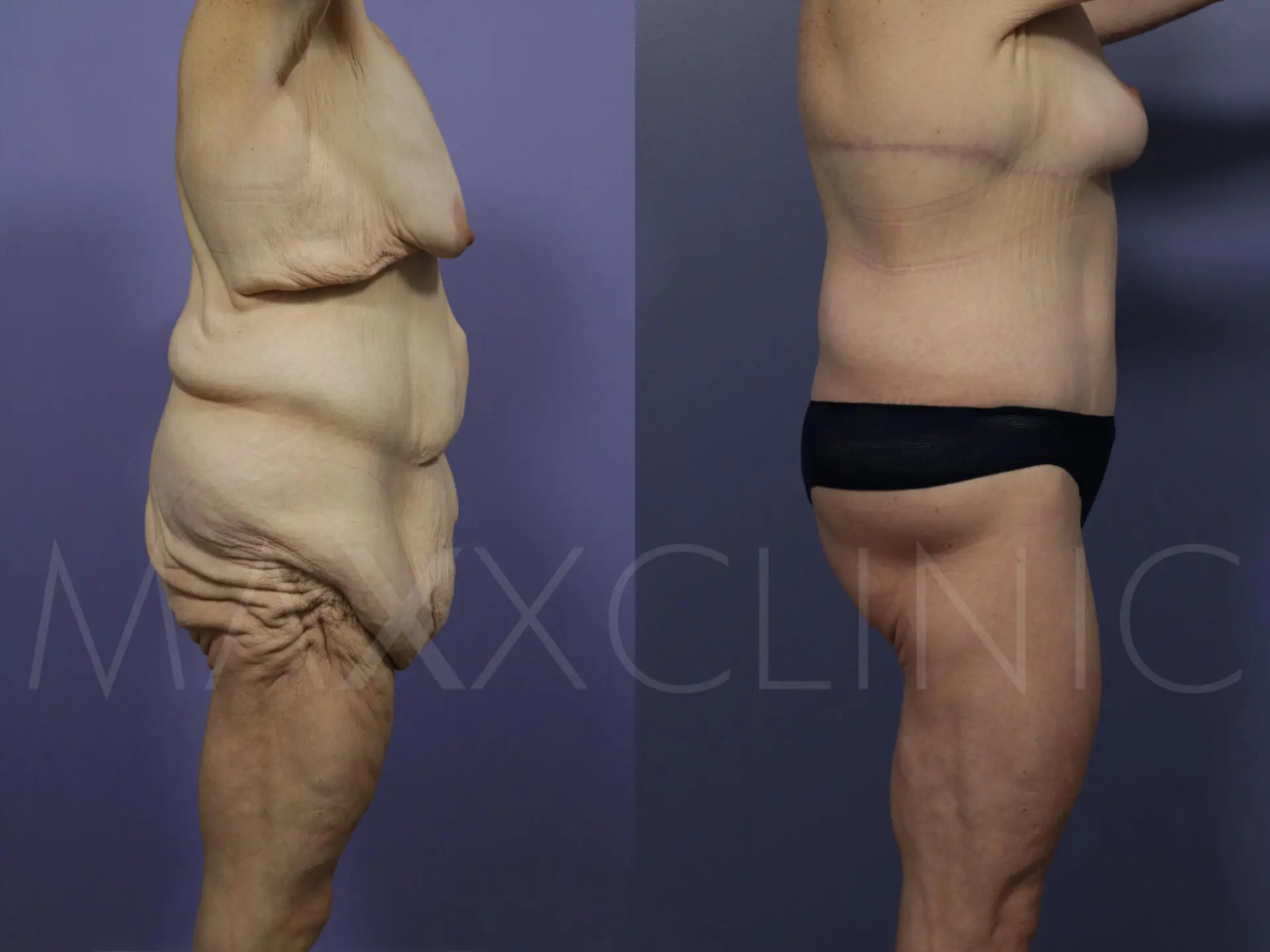 BodyLift3 (1)