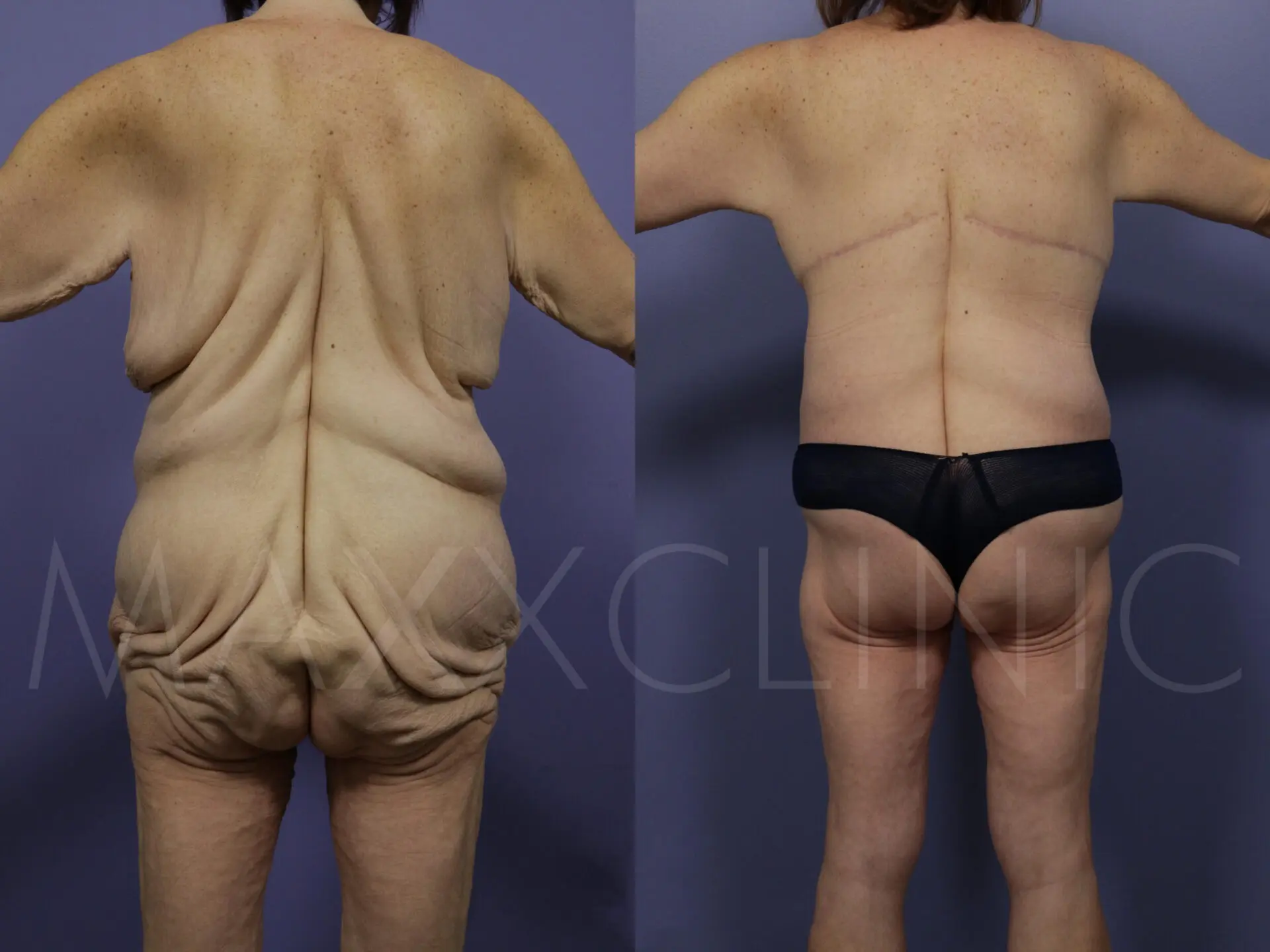 BodyLift3 (2)