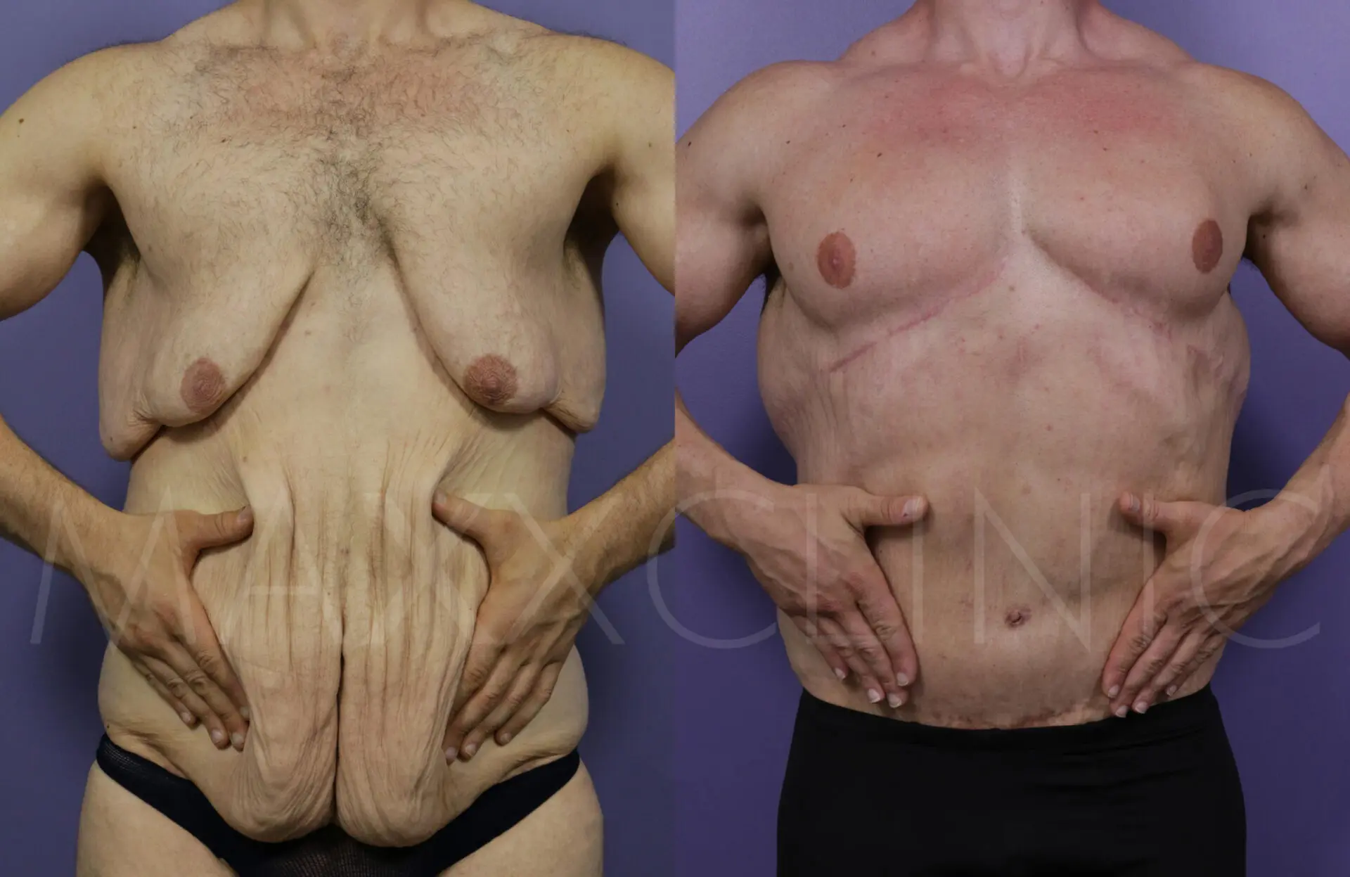 BodyLift4
