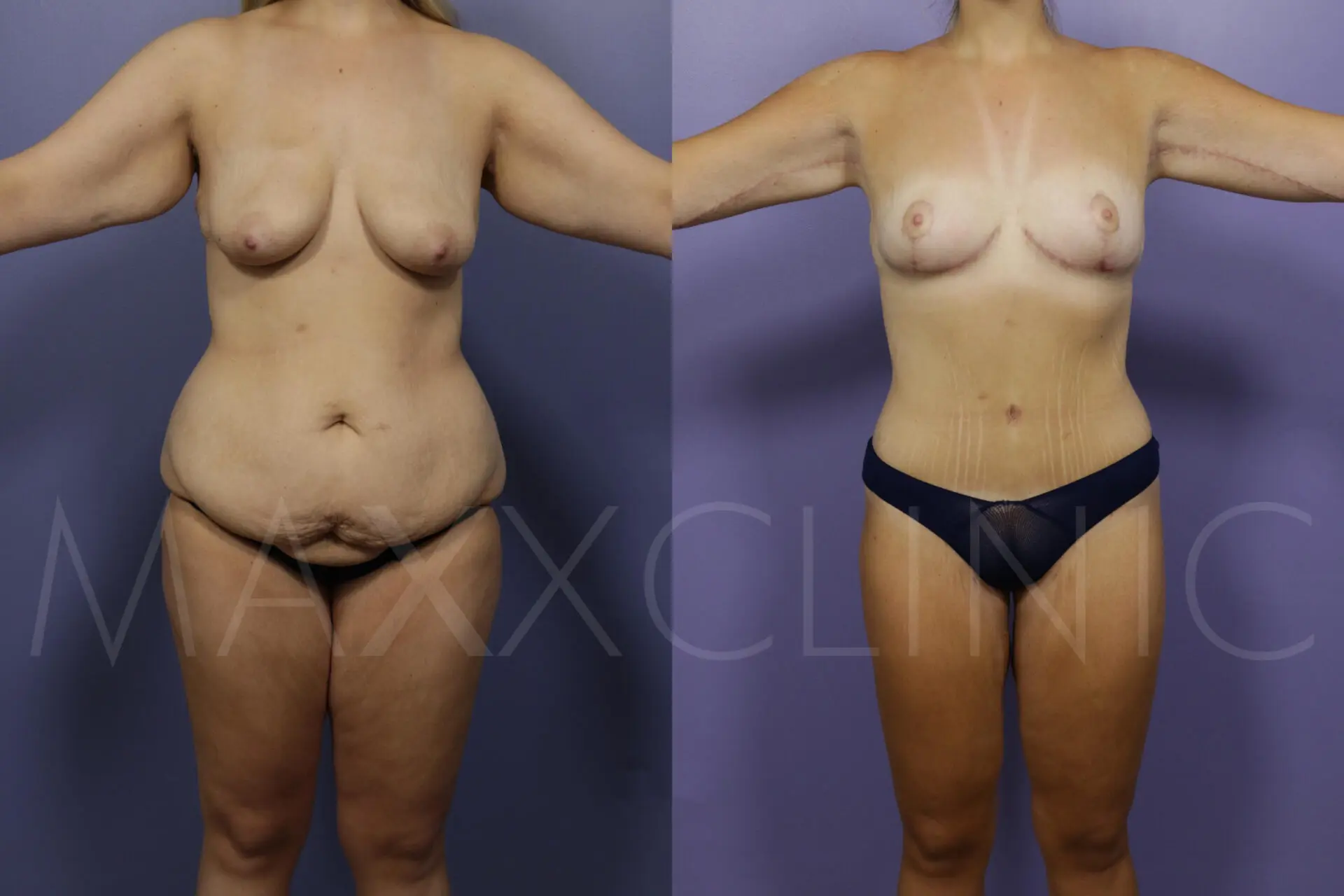 BodyLift5
