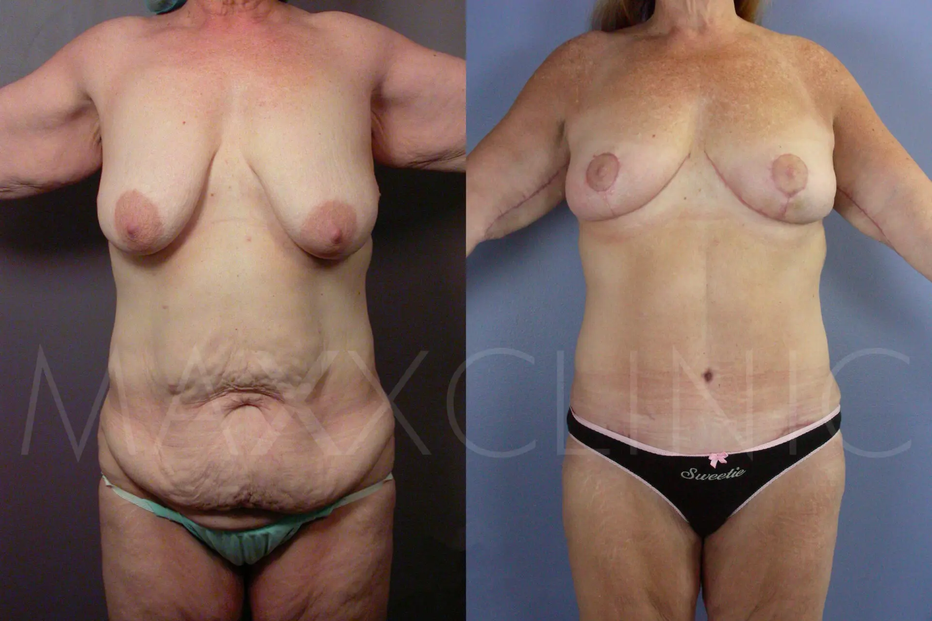 BodyLift6