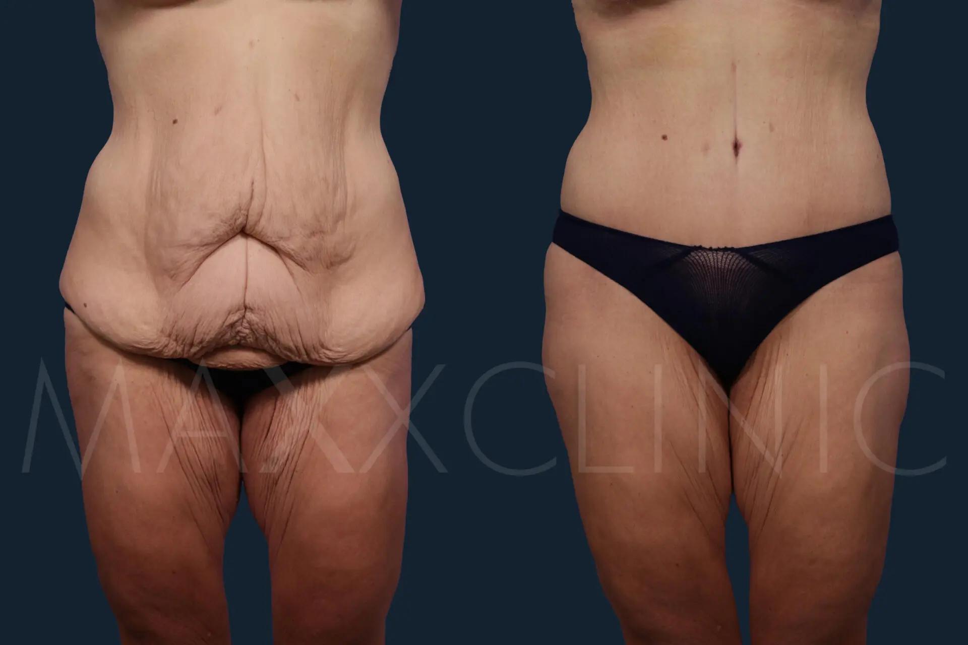 BodyLift7