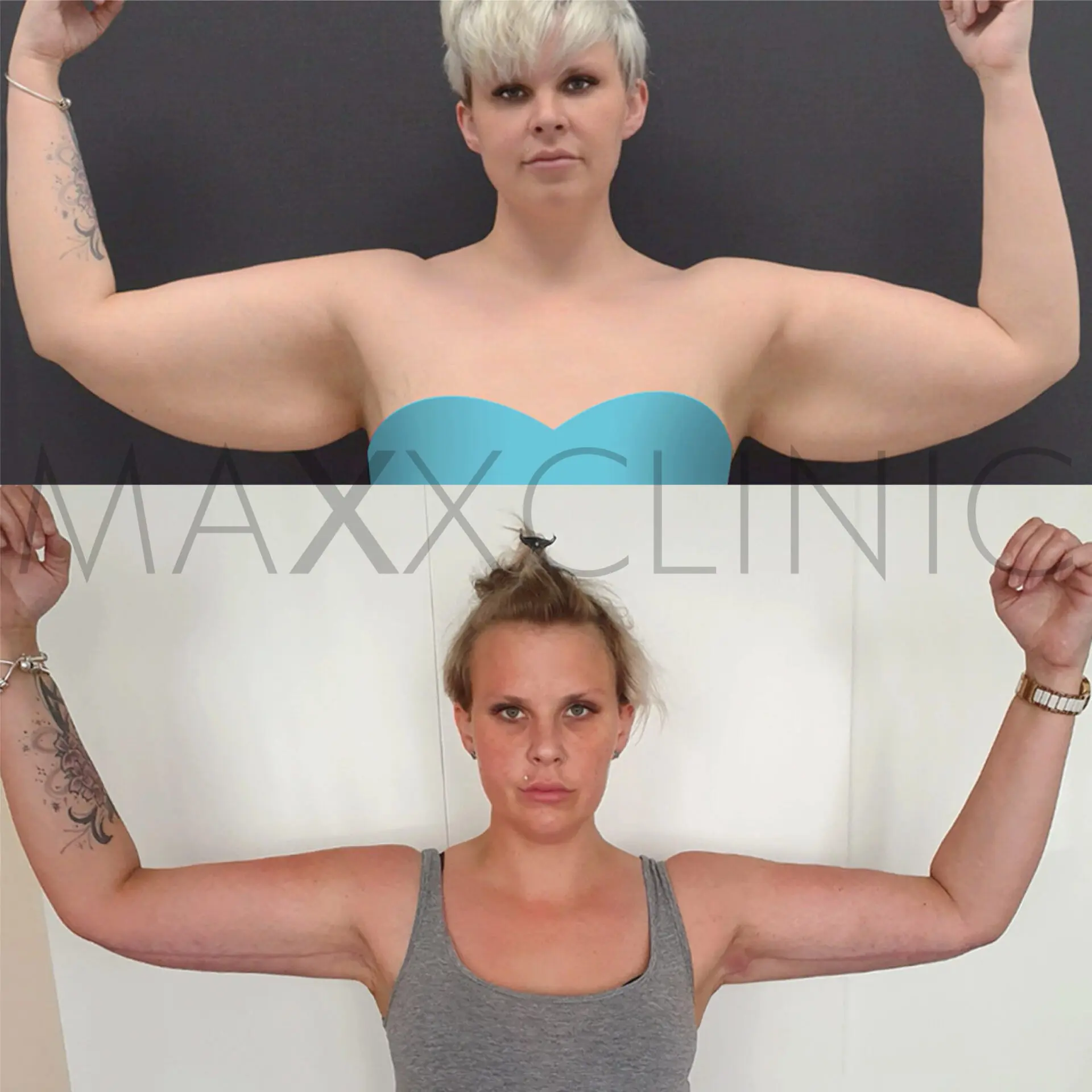 arm-lift