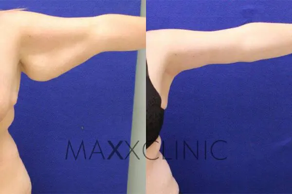 armlift-beforeafter1