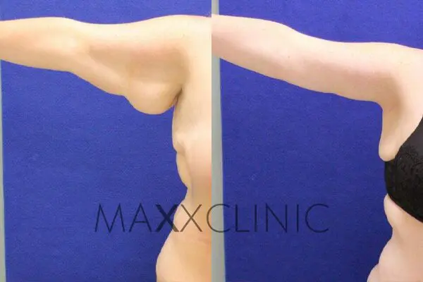 armlift-beforeafter2