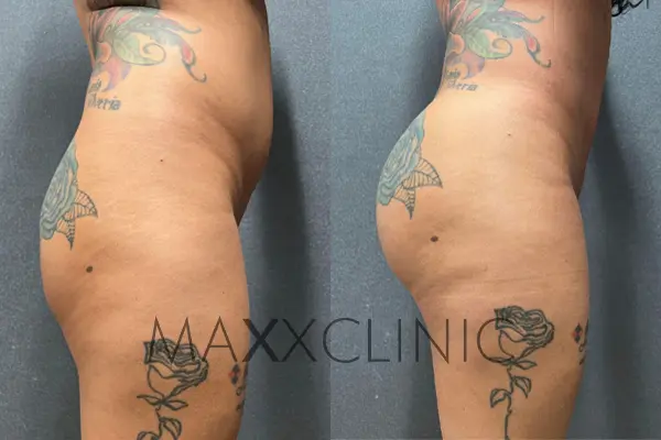 bbl-before-after1