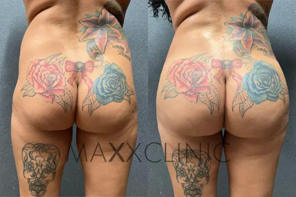 bbl-before-after2