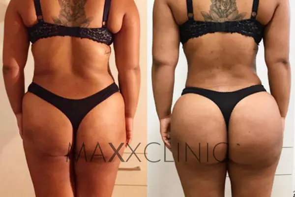 bbl-before-after3