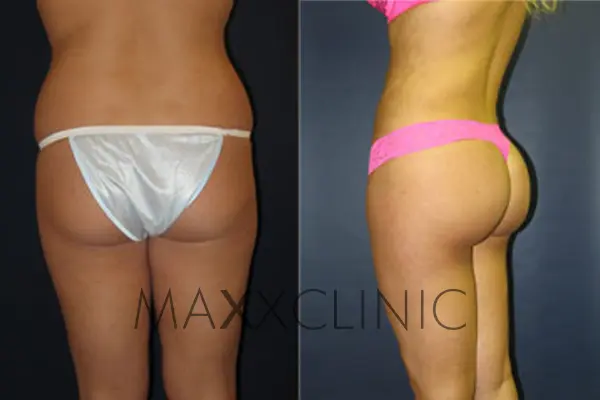 bbl-before-after5