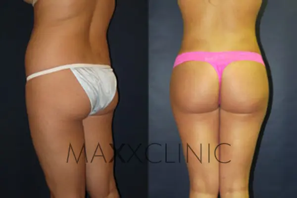 bbl-before-after6