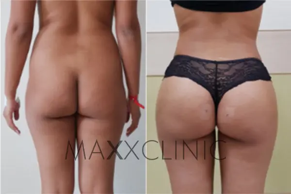 bbl-before-after7