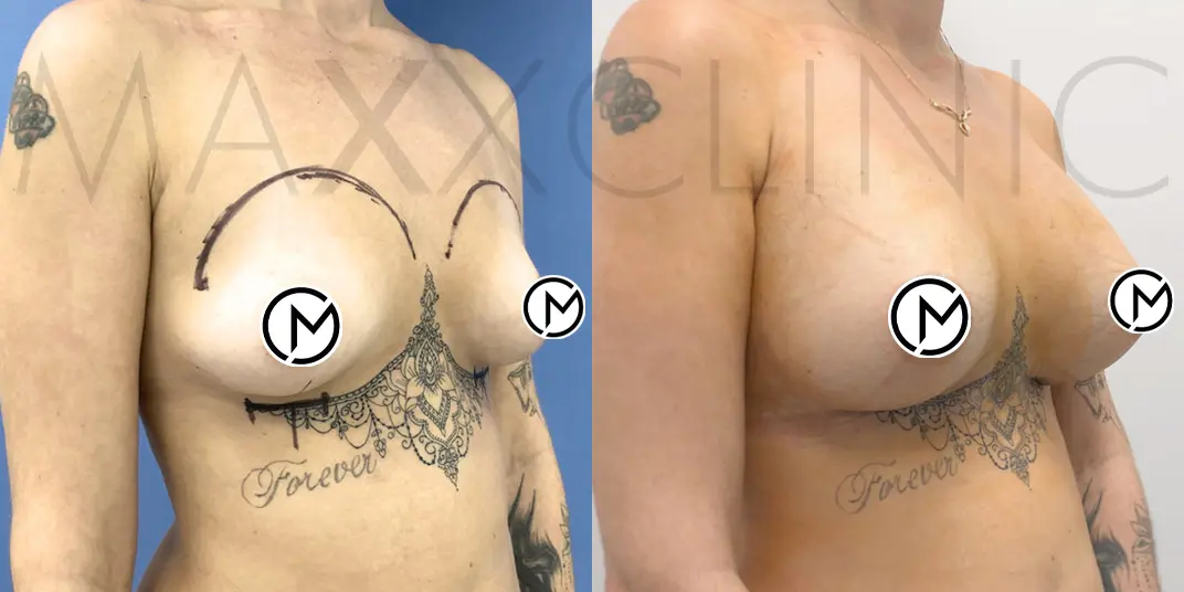 breast-augmentation (2)