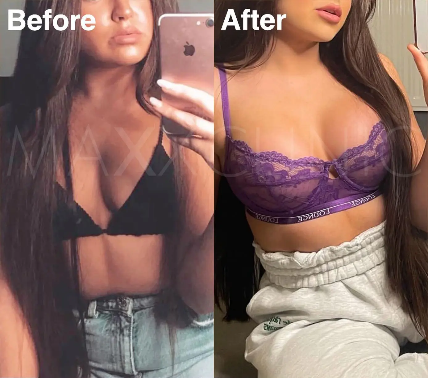 breast-augmentation-Logo
