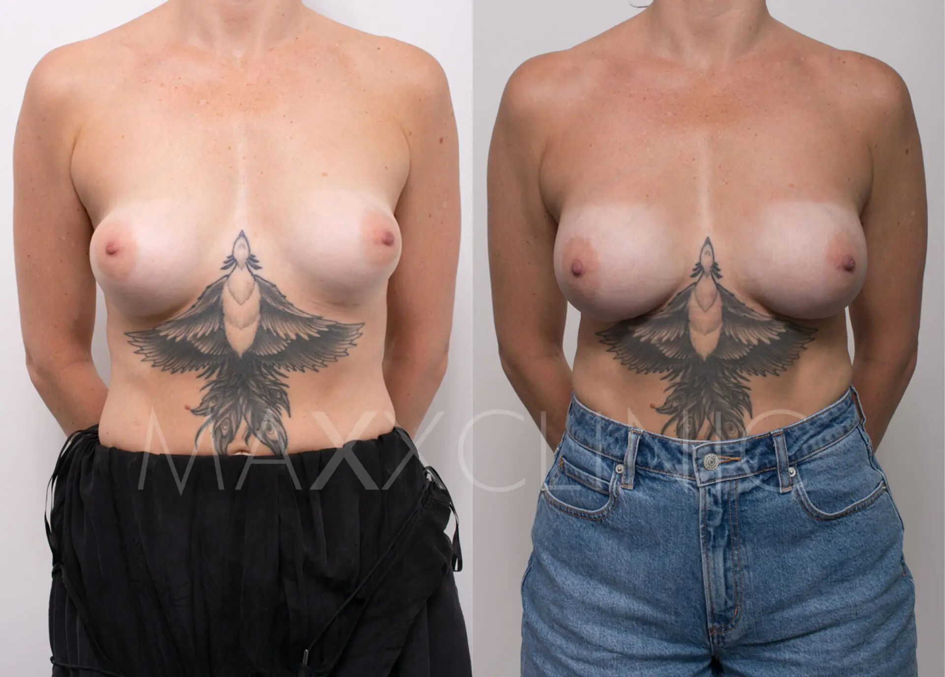 breast-implant-revision-ba
