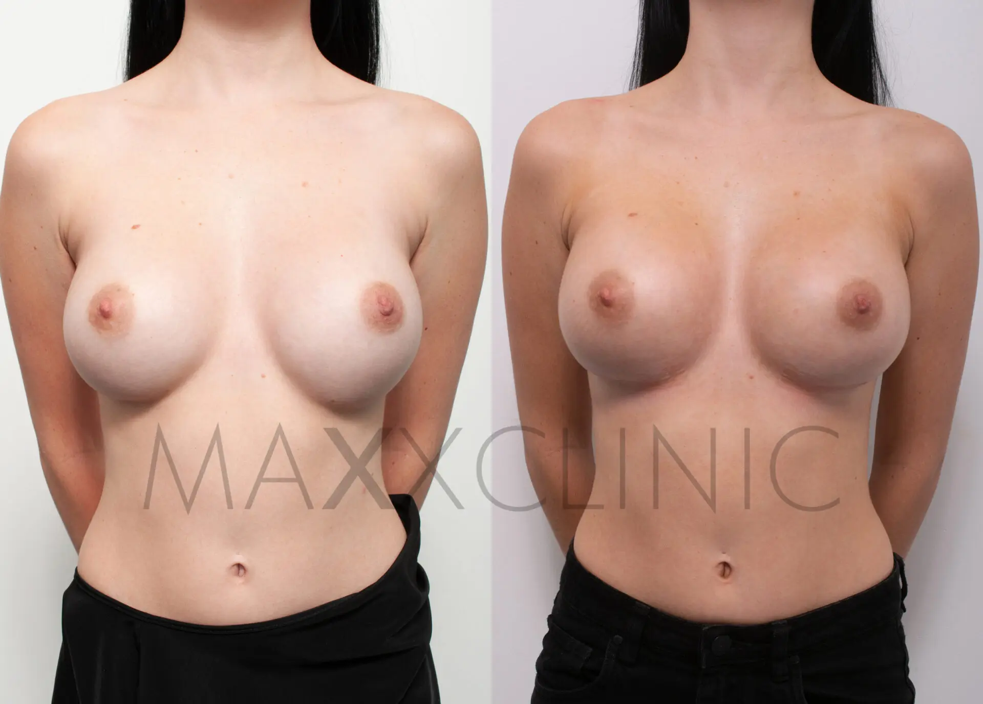 breast-implant-revision-ba5
