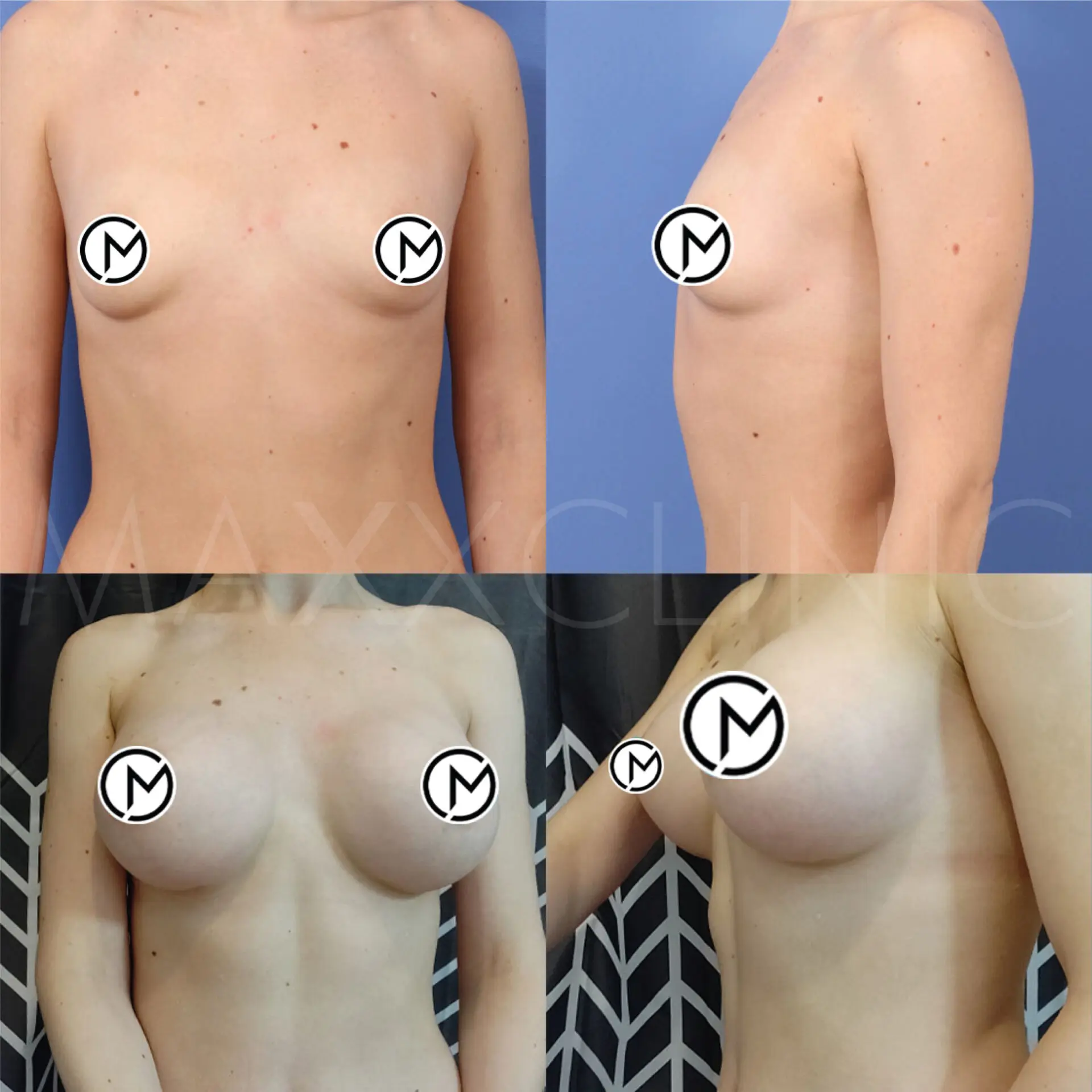 breast