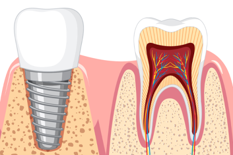 Dental Implants